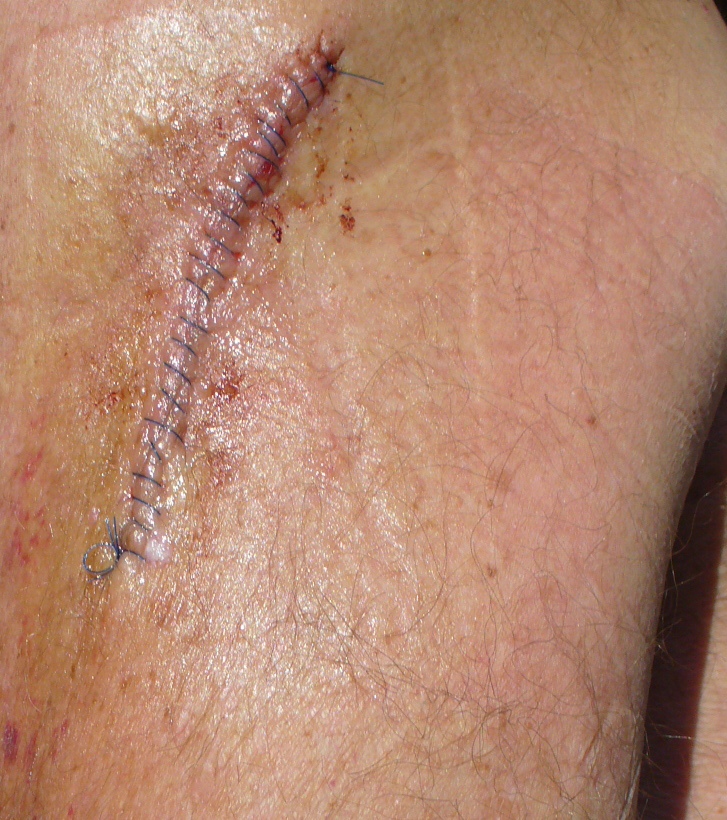 Three inch incision!